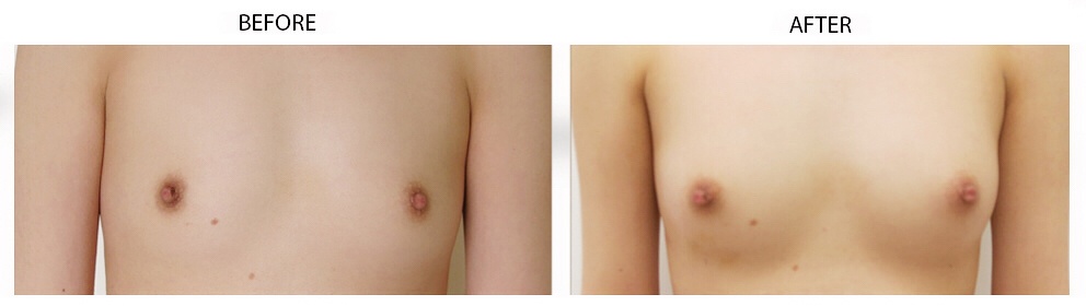 Breast Reconstruction Following Fat Transfer