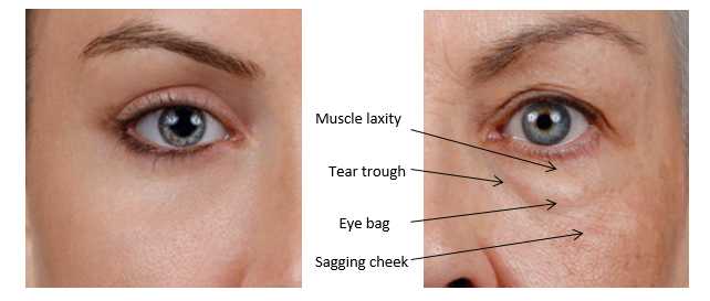 Eye Bag Removal in Sydney & Australia | Eye Bag Surgery Cost